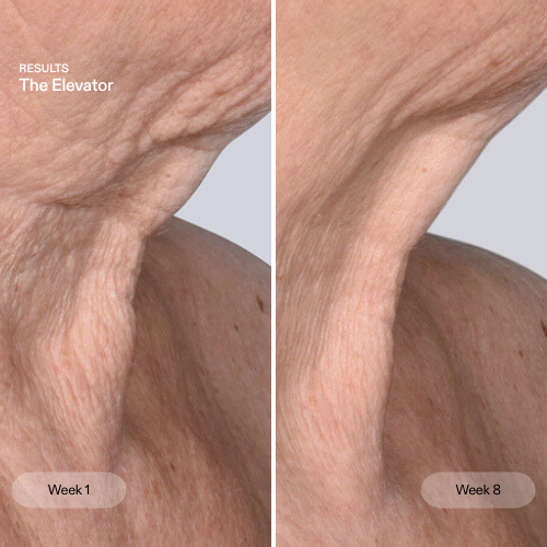 Before and after images showing the effects of the CurrentBody Skin The Ultimate Elevator on facial skin.