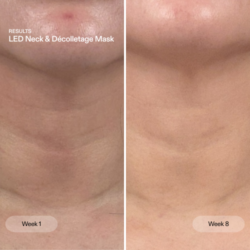 LED neck and décolletage mask by CurrentBody Skin, showing before and after results on skin appearance.